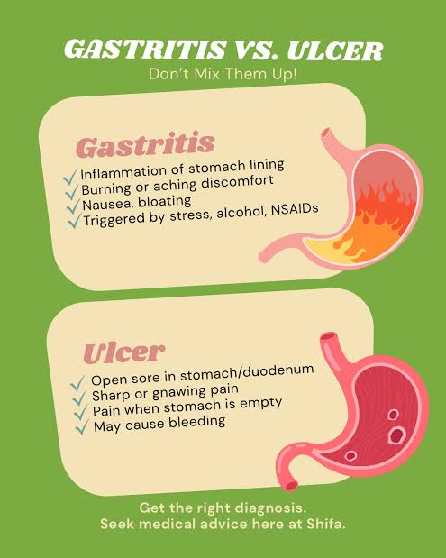 The difference between a stomach ulcer and&nbsp;gastritis.